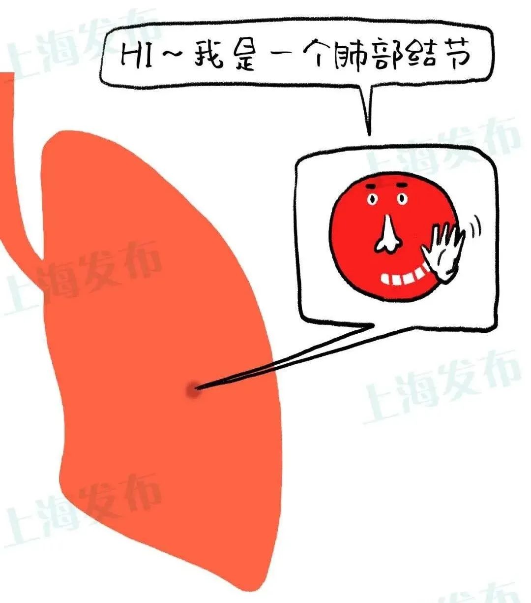 肺结节