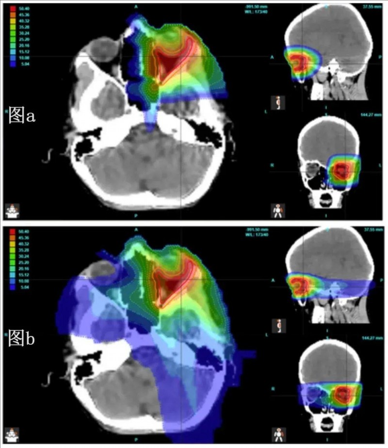 质子治疗眼部横纹肌肉瘤和普通放疗对比