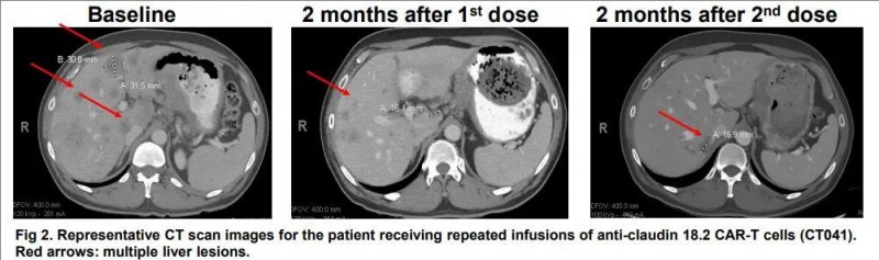 MD安德森CLDN18.2CAR-T治疗胃癌的效果