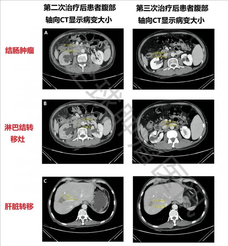 肠道菌群联合抗PD-1+抗VEGF,助晚期转移性结直肠癌患者