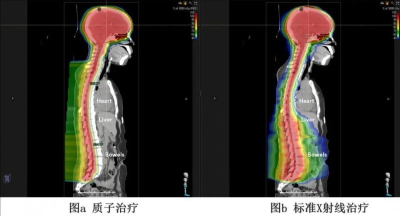 质子治疗和传统放疗对比