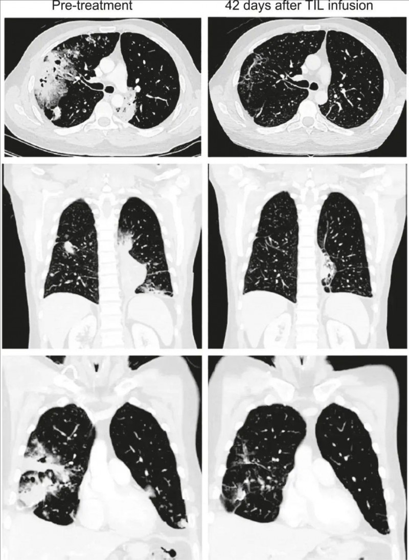 TIL细胞疗法治疗肺癌的效果