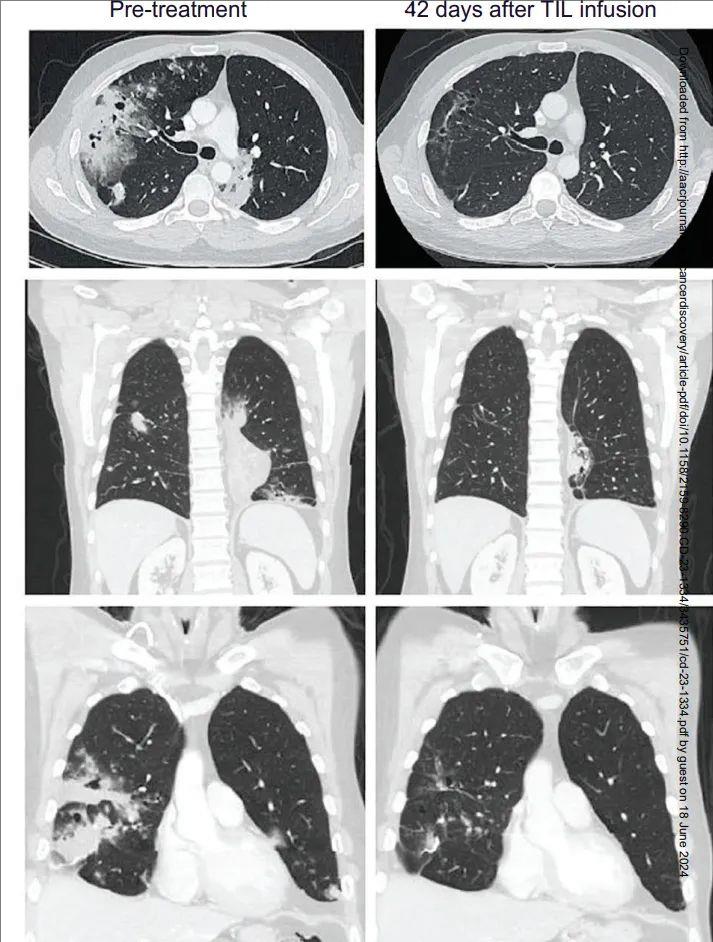 TIL疗法治疗晚期粘液性肺腺癌的效果