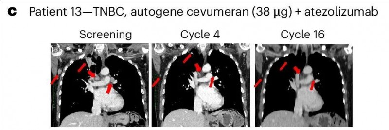 Cevumeran疫苗治疗乳腺癌的效果