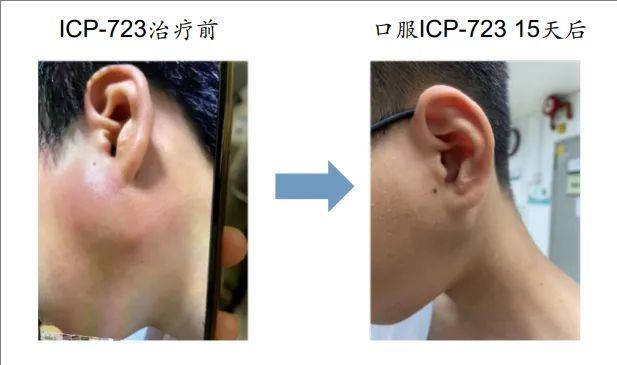 ICP-723治疗涎腺源性肿瘤的效果