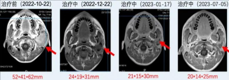 ICP-723治疗涎腺源性肿瘤的效果