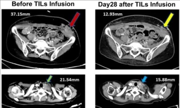 仅28天肿瘤显著消退!TIL疗法为宫颈癌患者点燃重生希望!