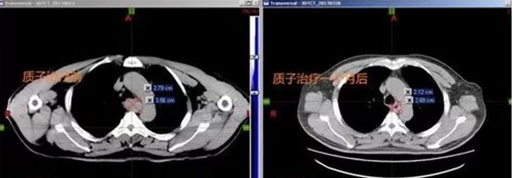 食管癌质子治疗前后对比