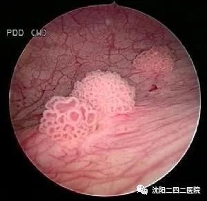 影像学表现及膀胱镜下改变