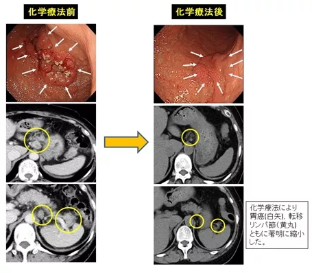 日本癌研有明医院肺癌手术