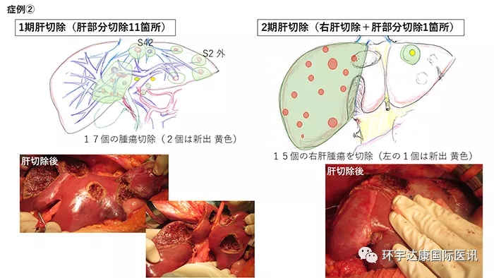 日本癌研有明医院治疗肝癌