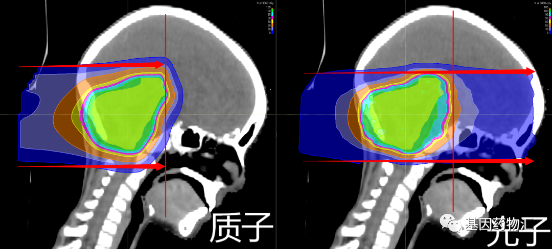 鼻咽癌质子治疗和传统放疗对比