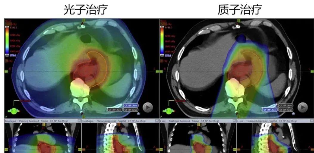 食管癌质子治疗和光子治疗对比