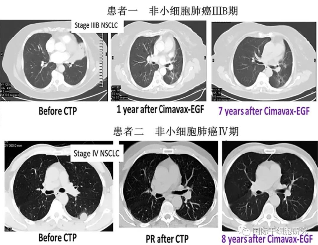 CIMAvax-EGF治疗肺癌的效果.