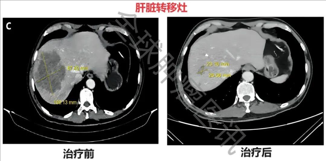 肠道菌群治疗结肠癌肝转移的效果