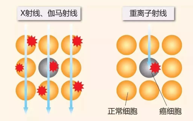 质子重离子治疗是什么意思