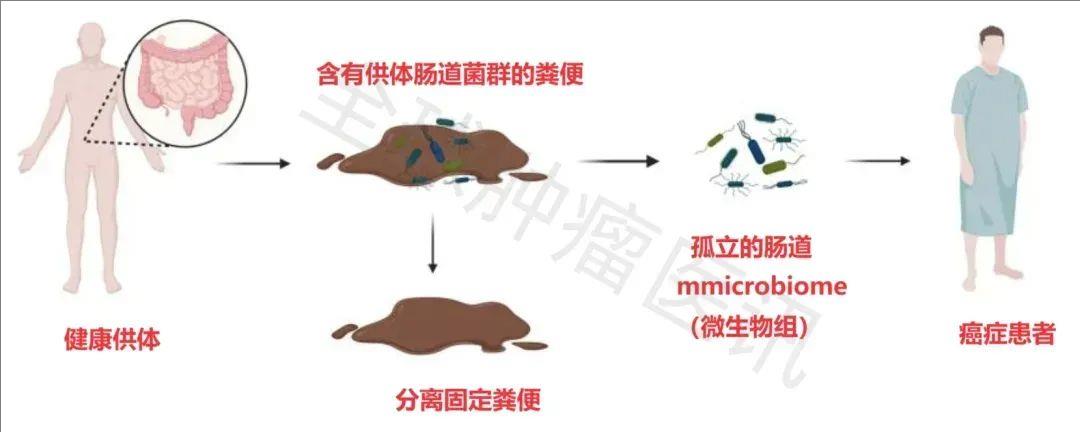 粪菌移植的流程